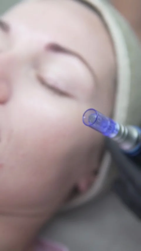 Close up of a microneedling device with a sterile needle tip next to a woman is Stock Footage 317609605