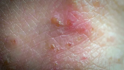 Close-up Microscopic View of Human Skin with Multiple Papules and Erythema 動画素材 309546959
