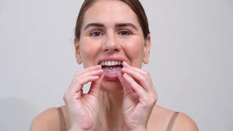 Close-up middle-aged woman putting on transparent aligners on the upper jaw Stock Footage 243457448