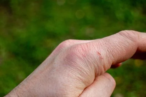 Close-up of a minor scratch cut on a human knuckle finger in nature Stock-Fotos