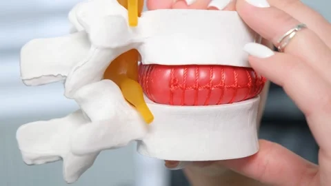 A close-up of a mock-up of an intervertebral hernia on the spine. Treatment of Stock Footage 241502724