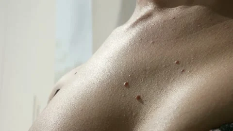 Mole on the skin of the body. Birthmark. Acrochordon Stock Photo