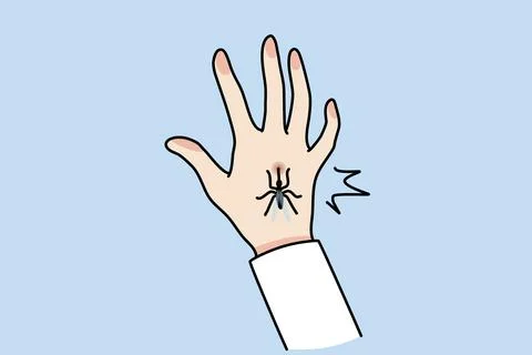Close up of mosquito bite hand. Bug or insect biting person leave spot or mark. Stock Illustration