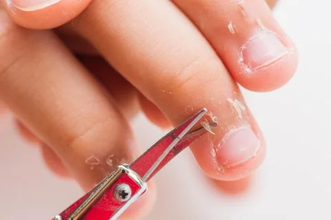 Close up mother using scissors cut dry skin on child's fingers, Eczema Dermat Stock Photos