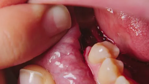 Close-up of a mouth after tooth extraction surgery Stock Footage 346472132