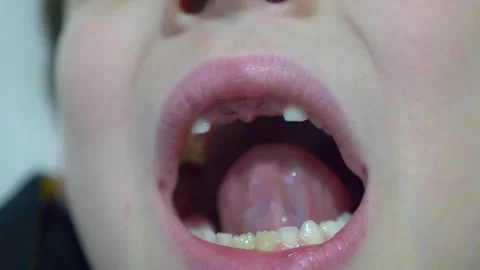 Close-up of the mouth of a child whose front milk teeth have fallen out Stock Footage 260480711