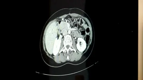 Close up MRI of the brain sagittal plane cysts tumors bleeding swelling Stock Footage 336569312