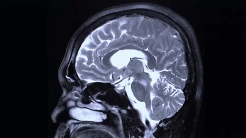 Close up MRI of the brain sagittal plane cysts tumors bleeding swelling Stock Footage 336569316