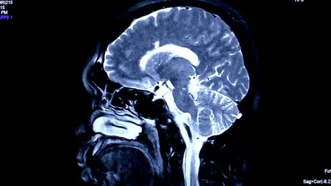 Close up MRI of the brain sagittal plane cysts tumors bleeding swelling Stock Footage 336569318