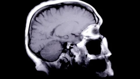 Close up MRI of the brain sagittal plane cysts tumors bleeding swelling Stock Footage 336569401