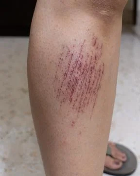 Close-up of multiple scratch marks on the leg Stock Photos