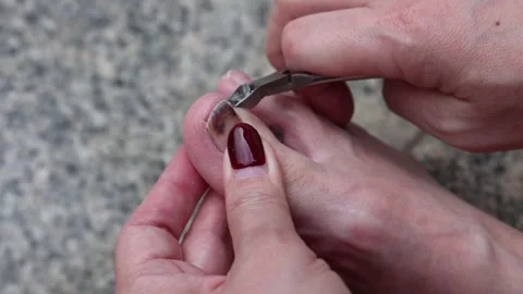Close up nail care process for bruised toenail with dark discoloration Stock-Footage 335690289