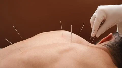 Close-up needle in the back of man during acupuncture procedure on a brown ba Foto stock