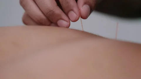 Close up of needles being put into skin Stock Footage 131872826