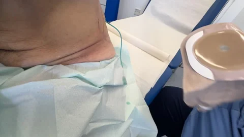 Close up of nurse hands fitting new nephrostomy pouch for kidney drainage. Stock-Footage 333910220