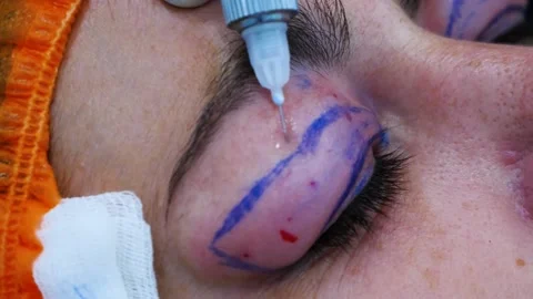 Close up od a surgeon puts an injection in the eye. Surgical eye marking Stock Footage 145602534