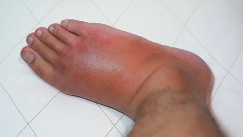 Close up old man right foot, Ankle wounded waiting and swelling infectious Stock Footage 127035941