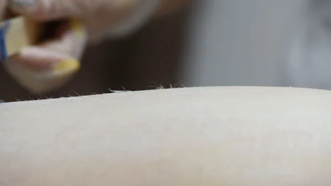 Close-up of one of the stages of the procedure for removing hair on the legs Stock Footage 118705579