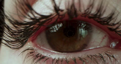 Close-up of the opening of the eyes with brown iris, all red with inflamed Vidéo 227746695