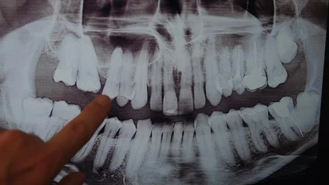 Close-up panoramic shot of the jaw. Dentistry and dental treatment. Stock Footage 252204646