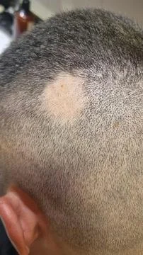 Close-up of a patch of alopecia areata Stock Photos