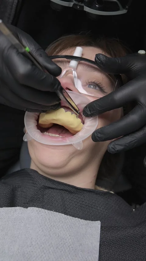 Close-up of patient during dental impression for crowns. Dentist shaping mold Stockbeeldmateriaal 341704968