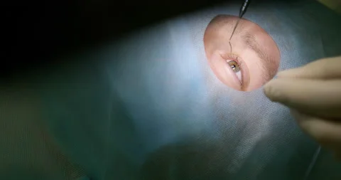 Close-up of patient eye lying on table in the operating room. Laser vision Stock Footage 154257401