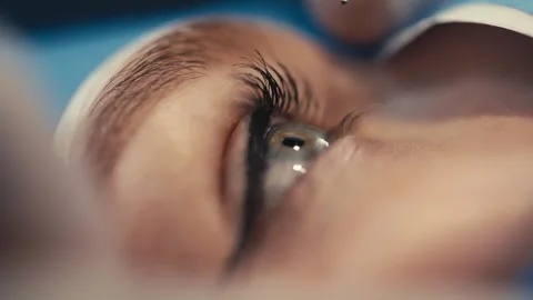 Close-up of patients eye during ophthalmic surgery, with surgical instrument Stock Footage 337285956