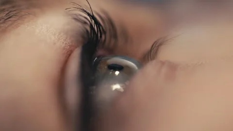 Close-up of a patient's eye during ophthalmic surgery, showcasing the intricate Stock Footage 337288287