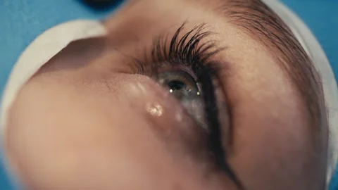 Close-up of a patient's eye during ophthalmic surgery, revealing detailed Stock Footage 337288339