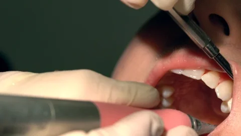 Close up patients gum bleeding during teeth cleaning at dentist dental office Stock Footage 110827476