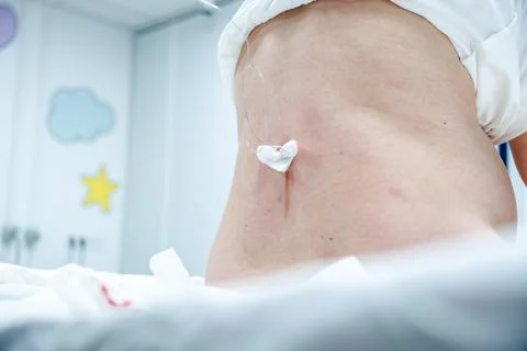 Close-up of a patient's lower back showing an epidural catheter and gauze d.. Stock Photos