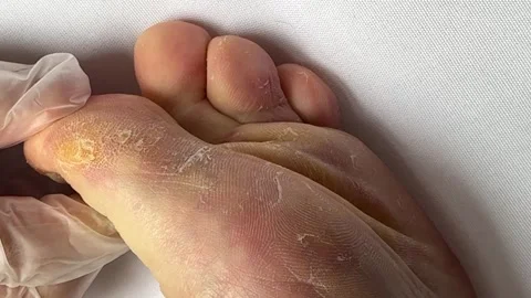 Close-up of a peeling and cracked human foot. Fungal infection, dry skin Vídeos de archivo 316492212