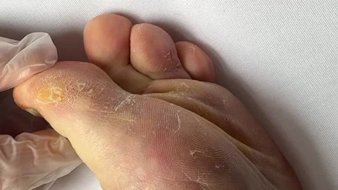 Close-up of a peeling and cracked human foot. Fungal infection, dry skin Vídeos de archivo 316492324