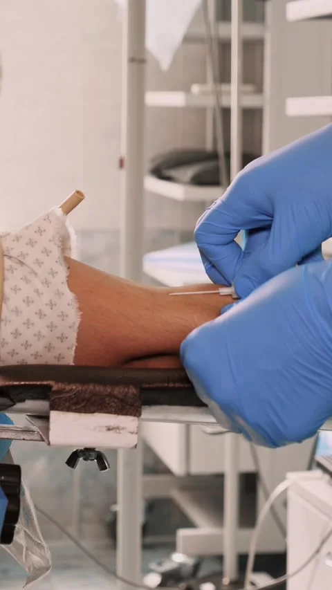 Close-up. Peripheral venous catheter insertion in operation room. medicine. Stock Footage 323366506