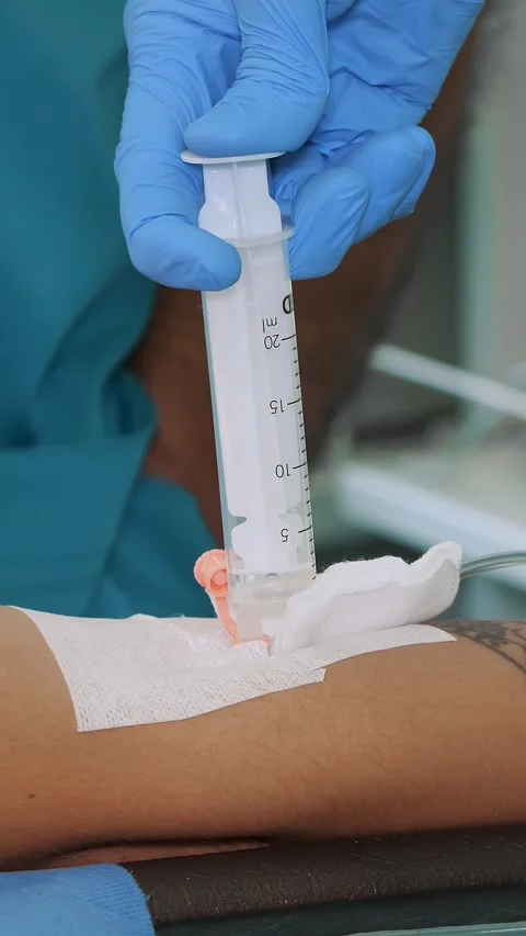 Close-up, peripheral venous catheter is installed on patient's arm. doctor or Stock Footage 314455143
