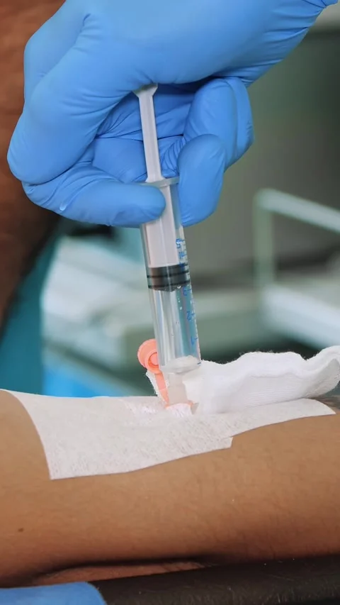 Close-up, peripheral venous catheter is installed on patient's arm. doctor or Stock Footage 317936686