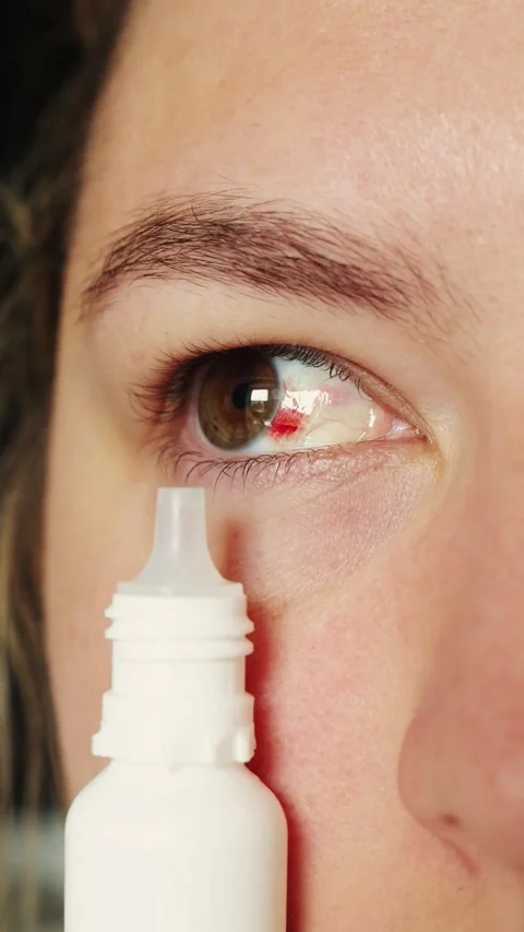 Close-up of a person applying eye drops to a red, irritated eye Stock Footage 340261155