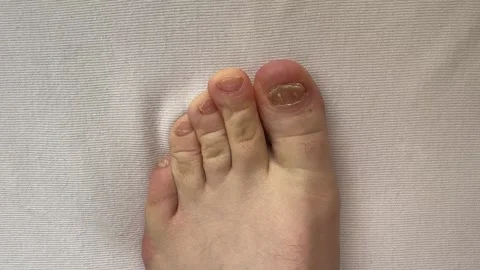 Close-up of the person nails affected by nail plate fungus. Ugly toes. Onychosis Stock Footage 299614155