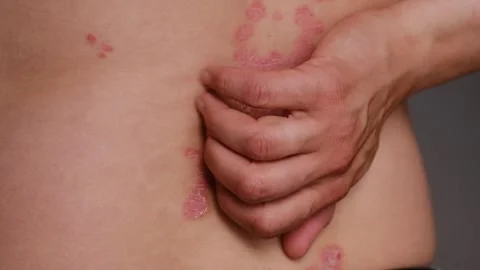 Close-up of person scratching back affected by psoriasis, showing skin Stock Footage 337461952