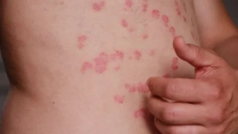 Close-up of person scratching psoriasis patches on skin, showing progression of Stock Footage 337462006