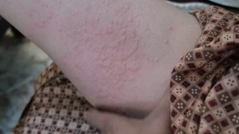 Close-up of a person scratching a severe red skin rash or hives allergy Stock Footage 330281636