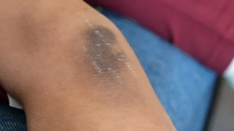 Close up of person scratching their elbow revealing dry skin patches and da.. Stock Footage 333029850