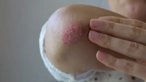 Close-up of a person touching a red, dry patch of skin on their elbow Stock Footage 300390865