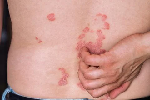 Close-up of a person's back showing psoriasis skin condition with red patch.. 스톡 사진