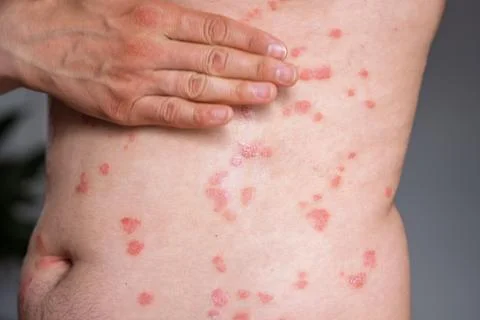 Close-up of a person's back showing psoriasis skin condition with red patch.. 스톡 사진