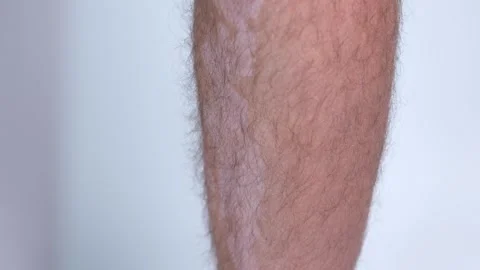 A close-up of a persons leg with spots from vitiligo disease on a white Stock Footage 321812447