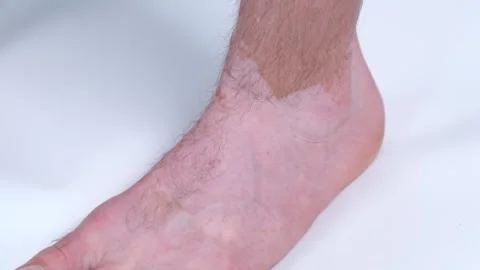 A close-up of a persons leg with spots from vitiligo disease on a white Stock Footage 324469317