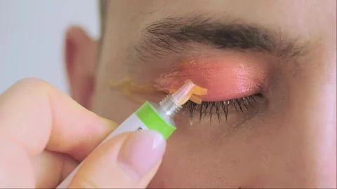 Close-up of a person's red eye due to an eye infection, conjunctivitis. Highligh Stock Footage 276183022