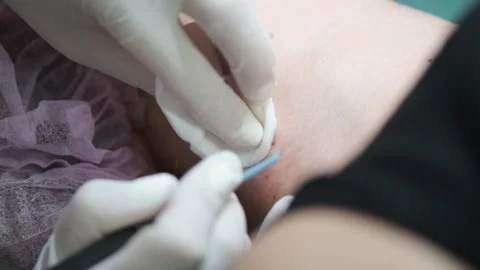 A close-up of a person's skin being treated by a professional with a focus .. Stock Footage 329179273
